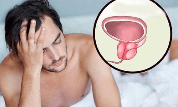 Sintomi di prostatite