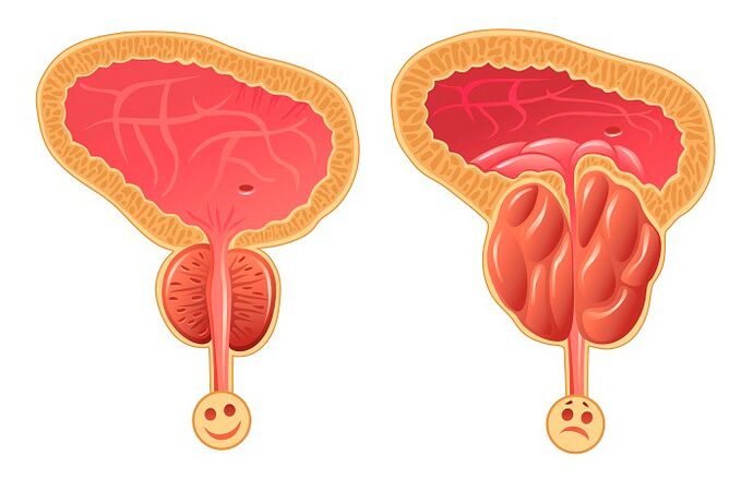 Prostata normale e infiammata