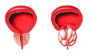 Prostata in condizioni normali (a sinistra) e infiammata da prostatite (a destra)