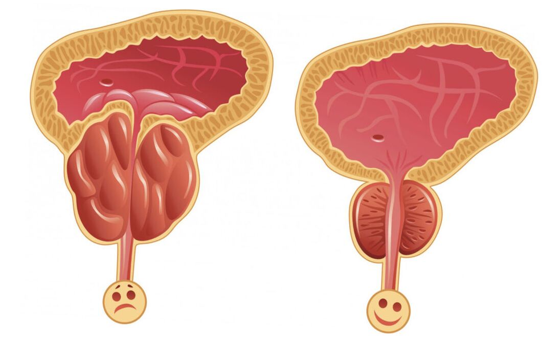 L'infiammazione della prostata con prostatite (a sinistra) e la ghiandola prostatica è normale (a destra)