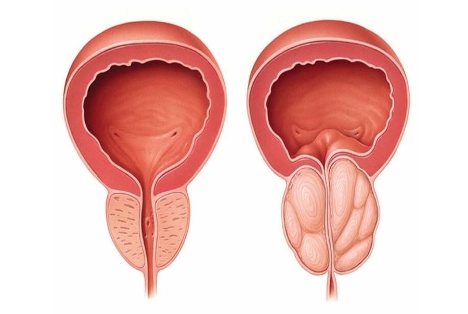 prostata normale e infiammata